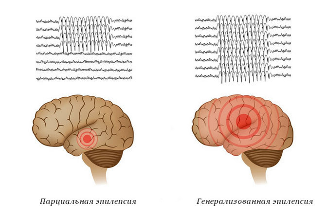 Парциальная и генерализованная эпилепсия