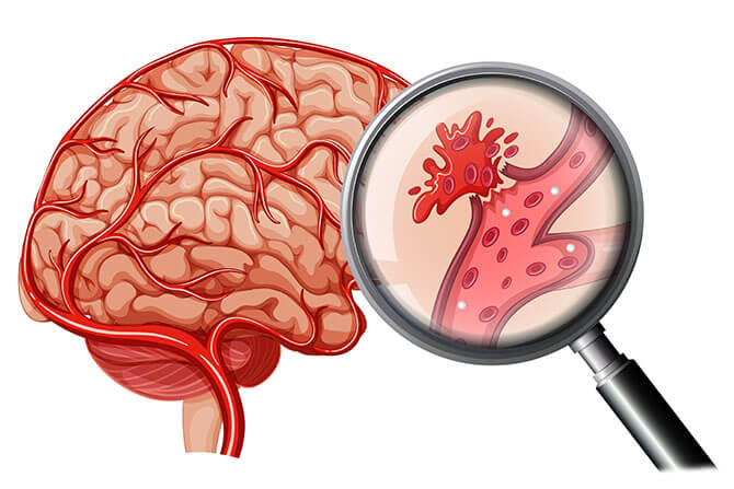 Геморрагический инсульт кровоизлияние головного мозга: симптомы