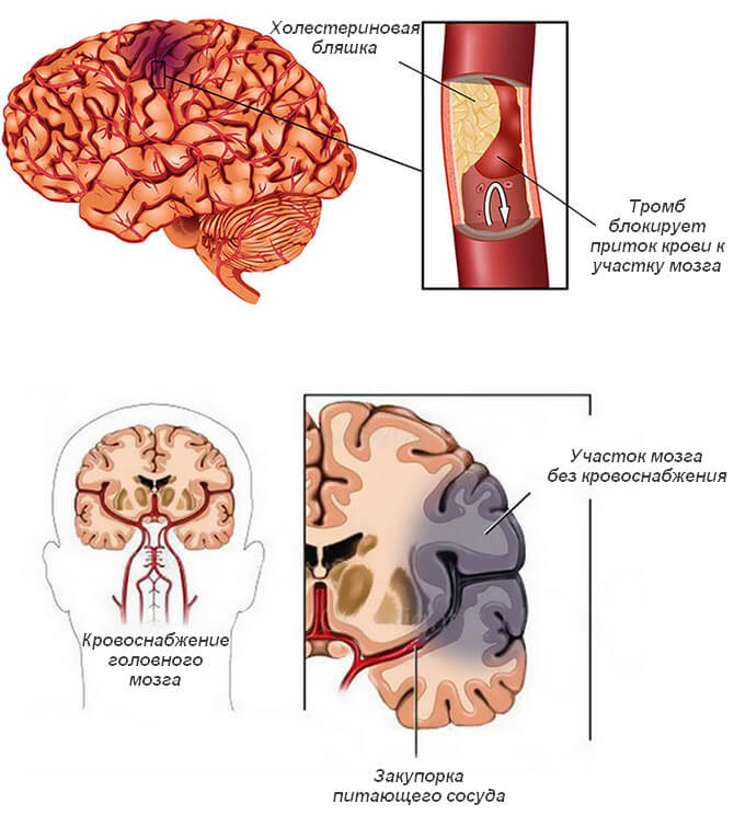 Инфаркт сосудов головного мозга лечение и последствия
