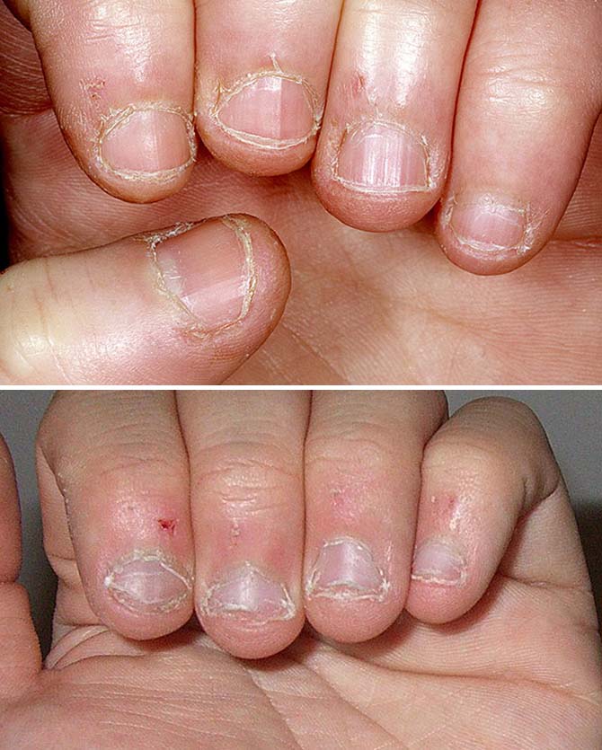 Ребенок грызет ногти и кожу и ногтей
