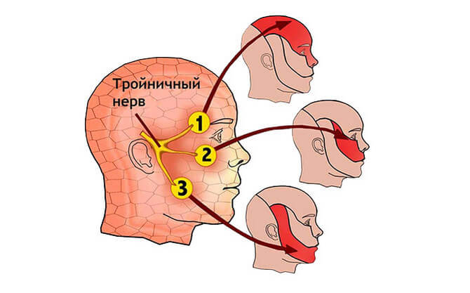 Невралгия тройничного нерва при герпесе thumbnail