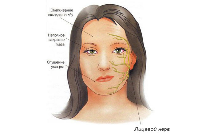 Отек лица при воспалении лицевого нерва