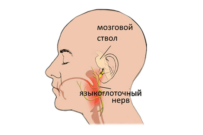 Синдром сикарда невралгия языкоглоточного нерва