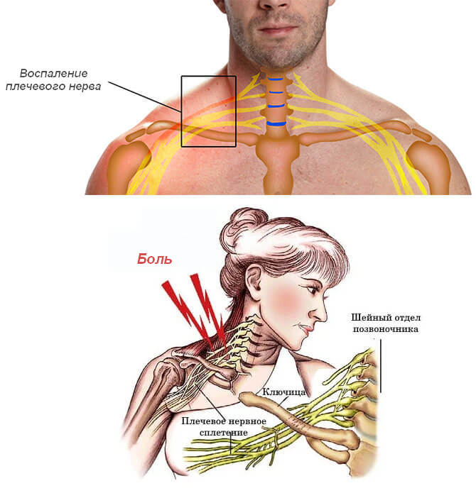 Разрыв нерва плечевого сустава